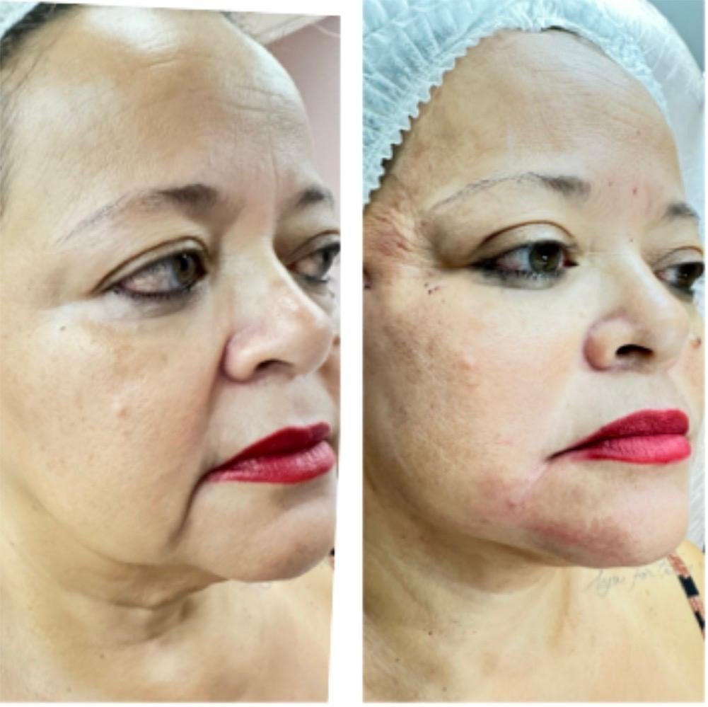 Fios de Sustentação e Botox - Antes e Depois
