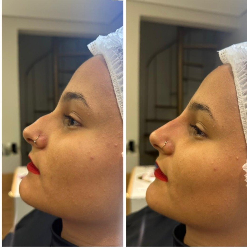 Rinomodelação - Antes e Depois